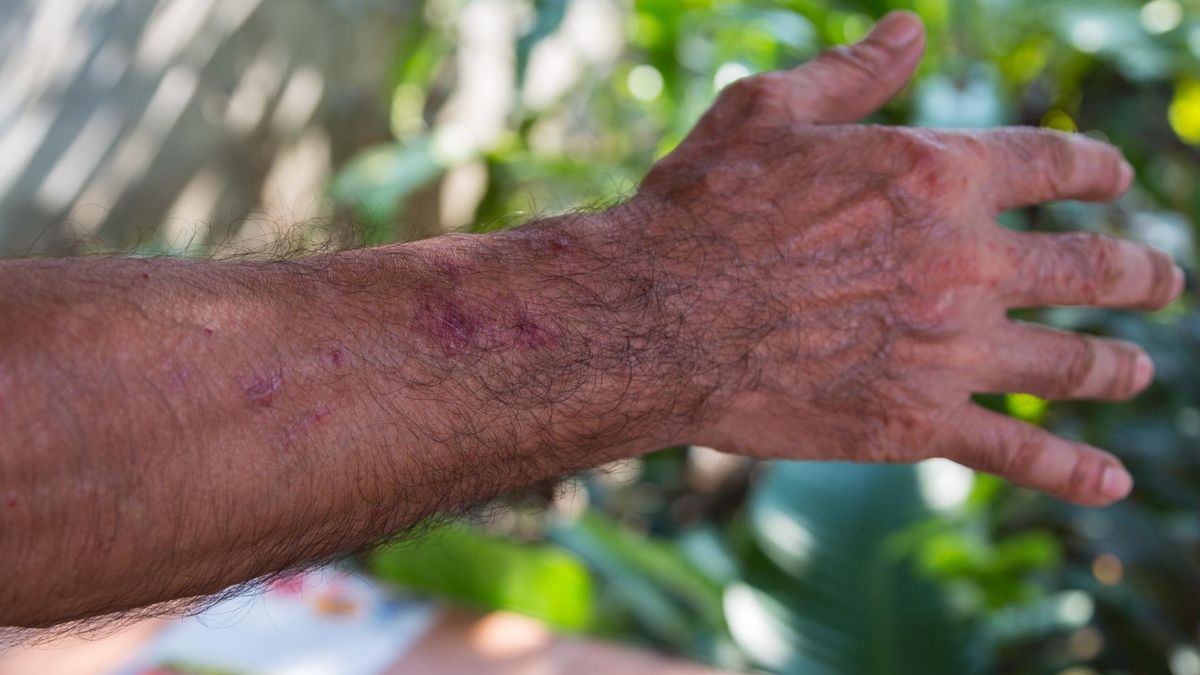 Alkohol oprócz organów wewnętrznych, wpływa także na kondycję skóry.