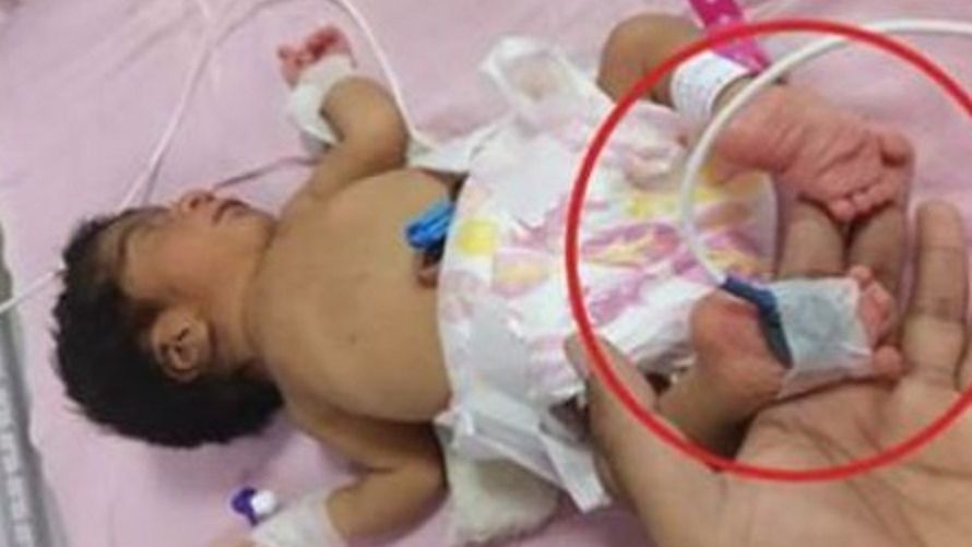 Noworodek z nóżkami w przeciwnym kierunku. "Takie przypadki zdarzają się raz na milion!"