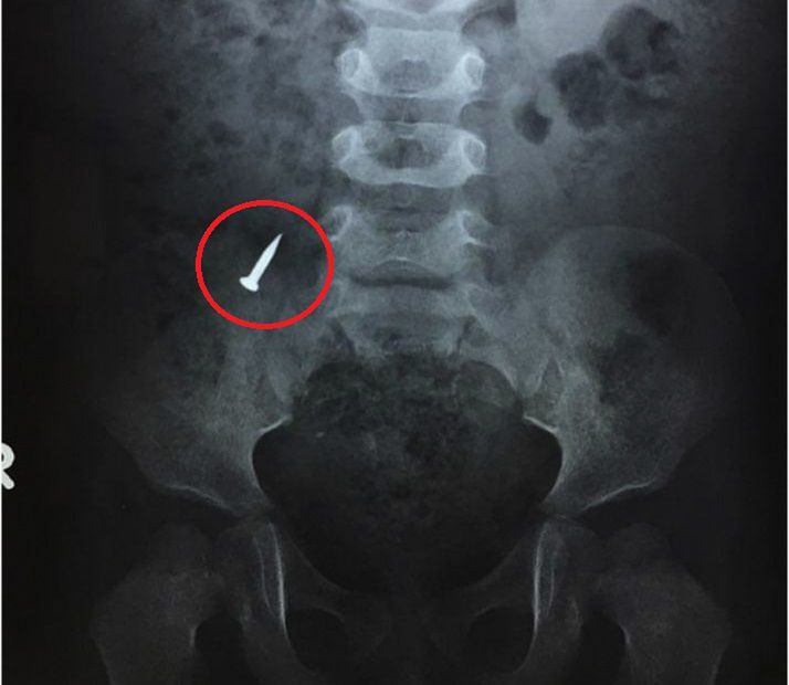 Zdjęcie RTG jamy brzusznej chłopca