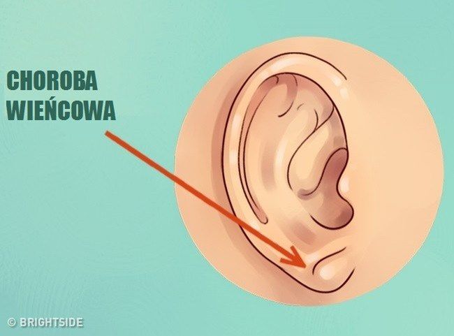 Wygląd uszu może wskazywać na choroby serca