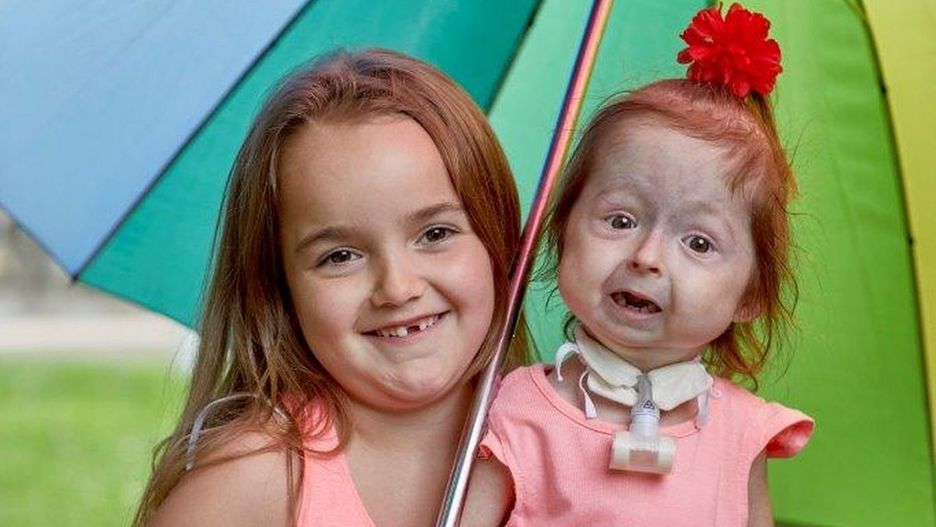 Dziś Isla ma 6 lat i jest radosnym, pogodnym dzieckiem