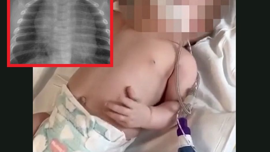 Lekarka ostrzega rodziców przez wirusem RSV. Te objawy wymagają natcyhmiastowej hospitalizacji