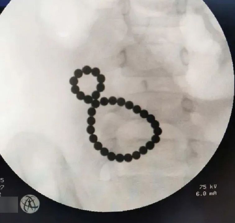 Prześwietlenie wykazało, że przyczyną wymiotów i bólu brzucha są magnetyczne kulki