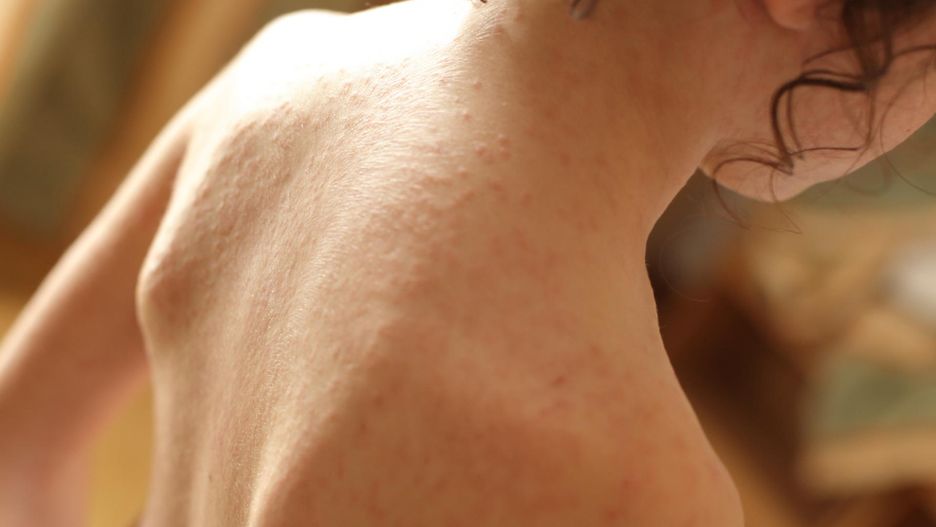 Specjaliści wskazują na to, że szkarlatyną zarazić się może każdy, niemniej jednak choroba ta dotyka głównie dzieci poniżej 10. roku życia.