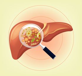HCV - charakterystyka, diagnostyka, leczenie, profilaktyka