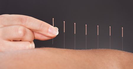 Akupunktura w ciąży, przed ciążą i przed porodem – na co pomaga?