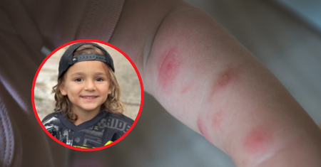 Rodzice sądzili, że ich dziecko ugryzł owad. Diagnoza była dużo gorsza