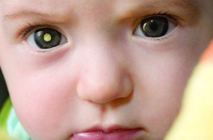 Czy zauważyłeś "złote oczy" na fotografiach twojego dziecka? To może być nowotwór