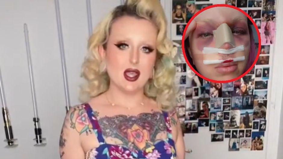 Marzyła o idealnym nosie, więc poddała się operacji. Powrót do zdrowia była dogą przez mękę