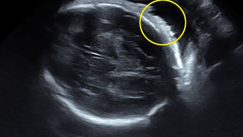 Na USG było widać włosy. Dziewczynka urodziła się z bujną czupryną