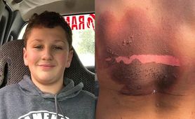 Nastolatek doznał poparzeń II stopnia, po tym, jak ładowarka do telefonu eksplodowała