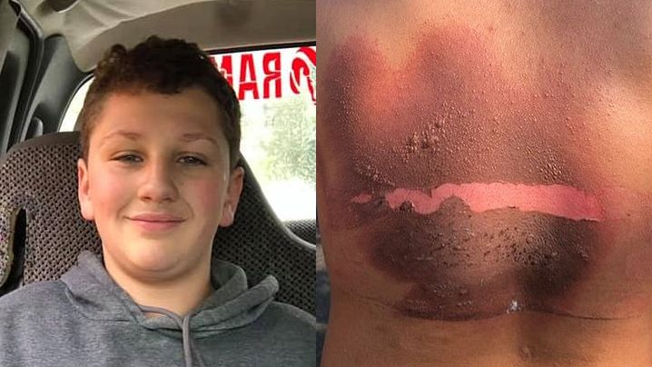 Colton poparzył się ładowarką