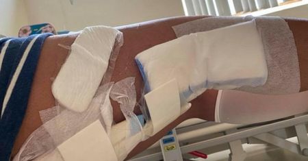 Guz na nodze okazał się nowotworem złośliwym. "Straciłam swoje życie"