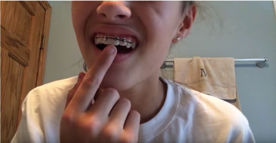 Aparat ortodontyczny zrobiony w domu