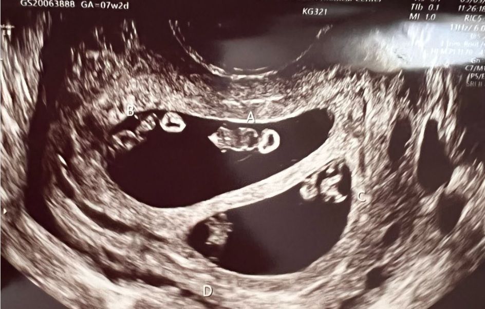 Podczas USG okazało się, że jest w podwójnej ciąży bliźniaczej