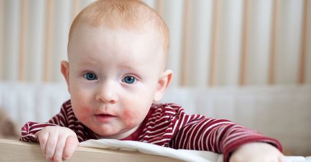 Czego nie należy podawać dziecku z alergią?
