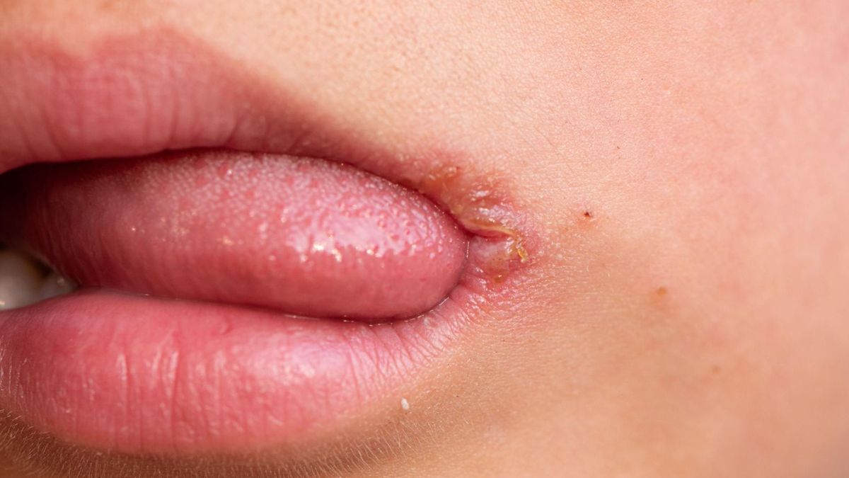 Do objawów niedoboru kwasu foliowego należą również zajady, afty, owrzodzenie języka.