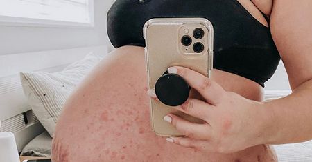 "Bycie mamą oznacza jedno: poświęcenie". Młoda matka pokazuje zdjęcia brzucha z licznymi rozstępami i pokrzywką. "To część mojej drogi"