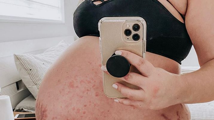 Rozstepy i pokrzywka w ciąży