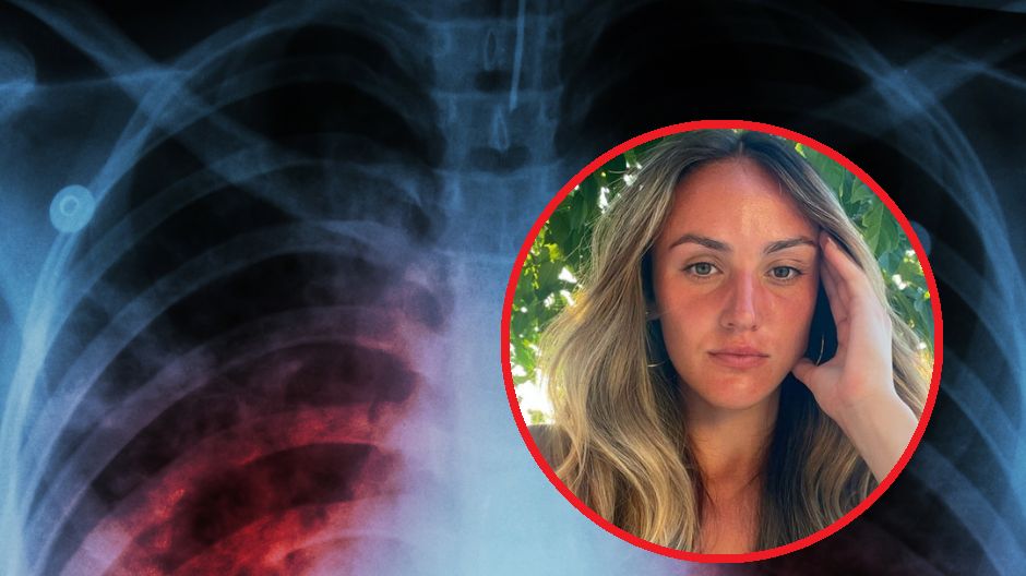 Kaszel z krwią to jeden z objawów zatoru płucnego