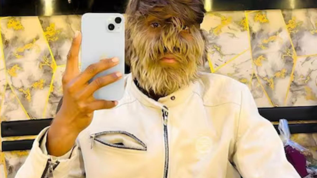 Mężczyzna z najbardziej owłosioną twarzą. 19-latek trafił do Księgi Rekordów Guinnessa