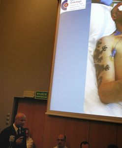 Sukces Polaków. Pierwsza taka transplantacja twarzy na świecie