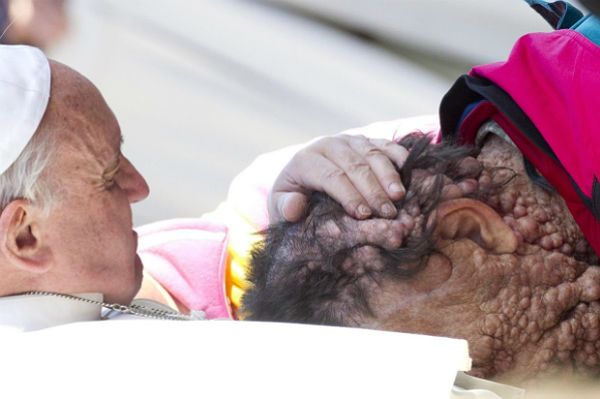 Chory mężczyzna o zdeformowanej twarzy wspomina swoje spotkanie z papieżem Franciszkiem