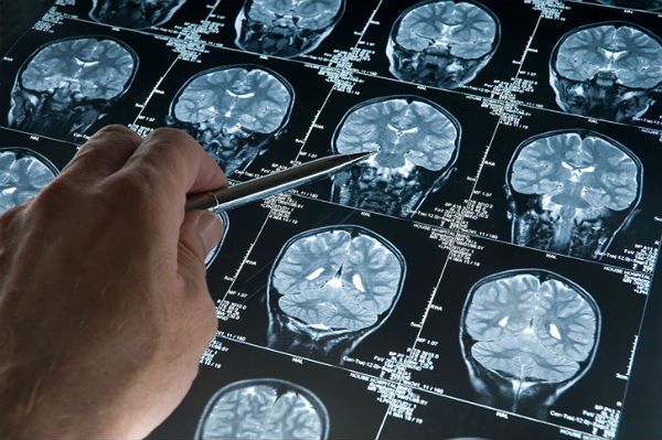 Polscy badacze przekształcili złośliwy guz mózgu w łagodny