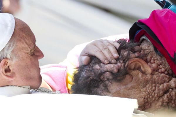 Chory mężczyzna o zdeformowanej twarzy wspomina swoje spotkanie z papieżem Franciszkiem