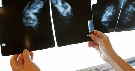 Rak piersi główną przyczyną zgonów kobiet po 35. roku życia