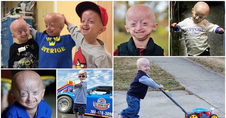 Progeria - przedwczesna starość
