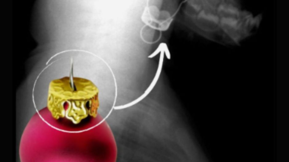 Niebezpieczne ozdoby choinkowe. Pielęgniarka pokazała zdjęcie