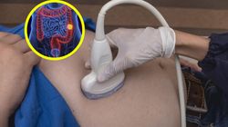 Tak objawia się rak jelita grubego. Zwykle rozwija się z łagodnych zmian