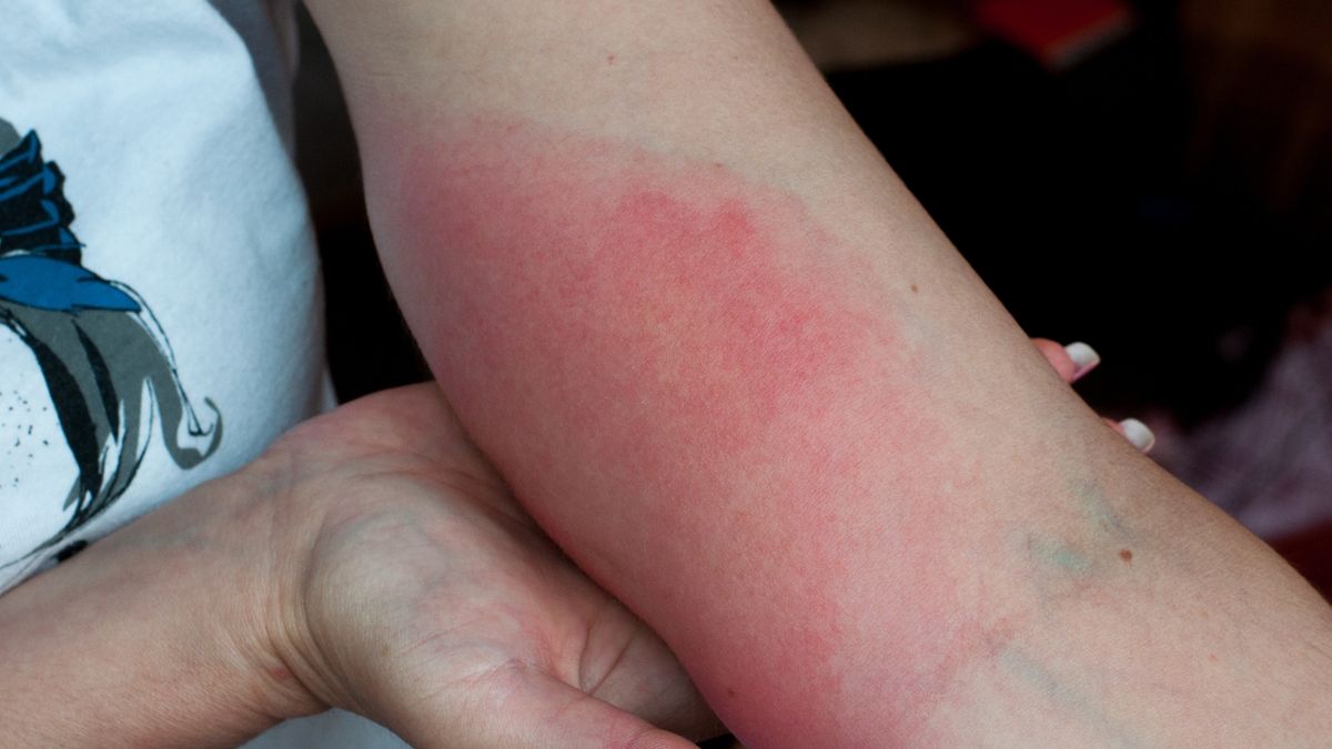 Zespół poboreliozowy obejmuje objawy charakterystyczne dla boreliozy