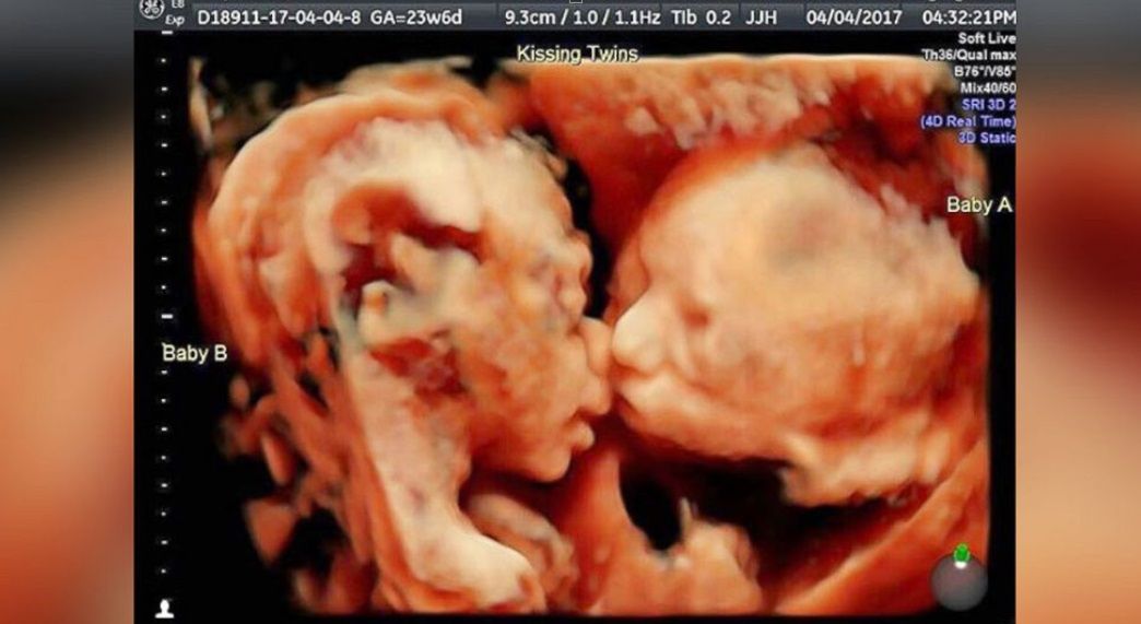 Była w szoku, kiedy zobaczyła USG. Badanie ujawniło nietypowe zachowanie bliźniaczek