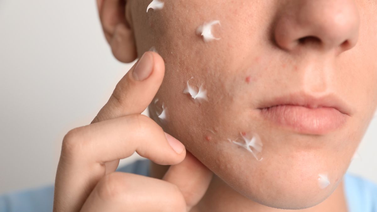 Aknemycin aplikuje się na obszary skóry, na których występują zmiany chorobowe