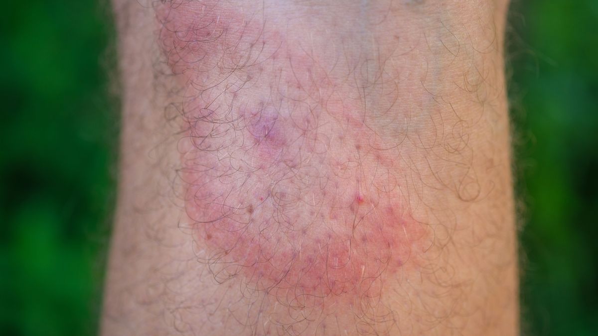 Rumień po kleszczu może osiągać różne rozmiary, czasem powoduje pieczenie lub swędzenie