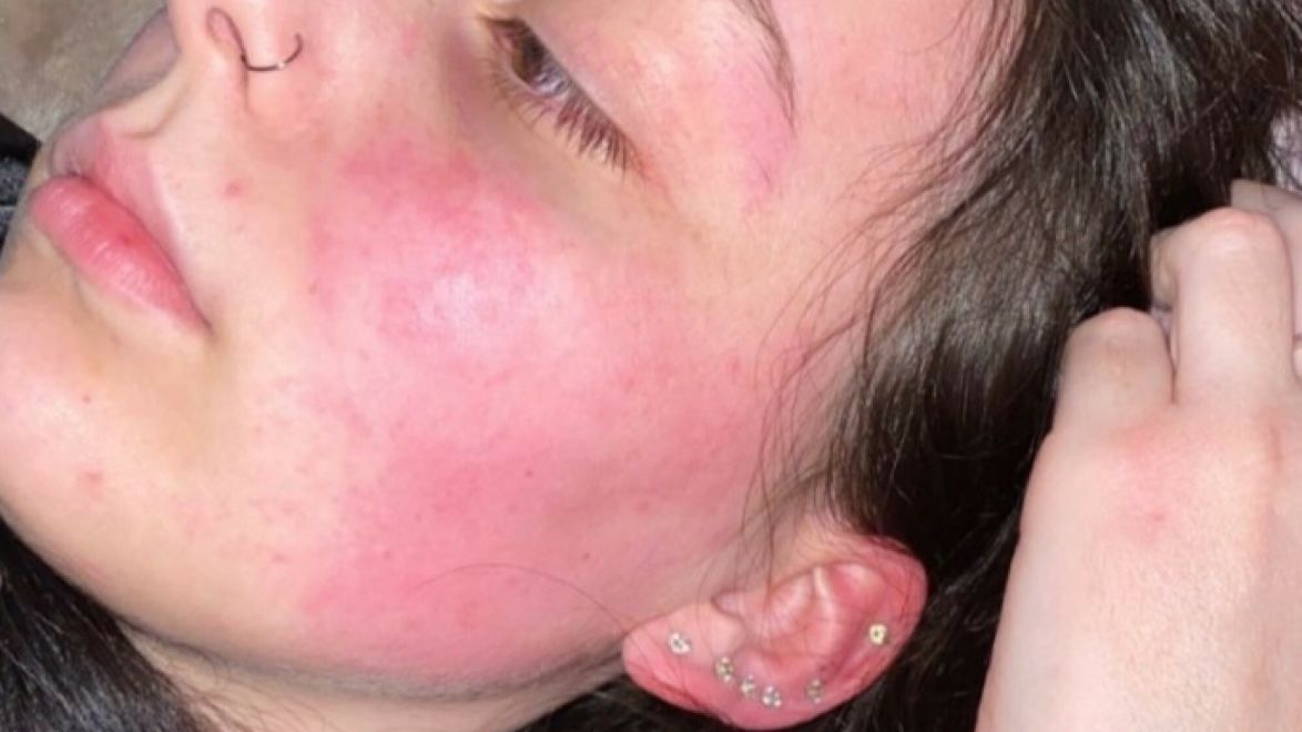 Sophie uczuliły substancje zawarte w ubraniach