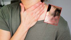 Ten nowotwór może podszywać się pod infekcję. Zdradza go jeden objaw 