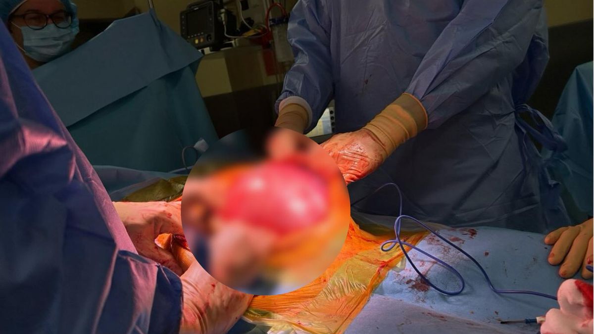 Torbiel jajnika miała średnicę 40 cm