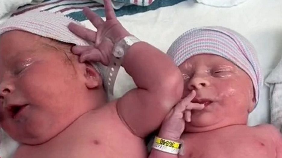 Kiedy się urodziły, lekarz był w szoku. Nigdy nie widział większej różnicy między bliźniakami