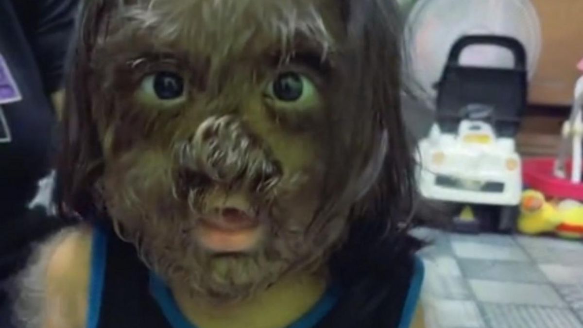 TikTokerka nagrywa filmy z dzieckiem, które cierpi na syndrom wilkołaka
