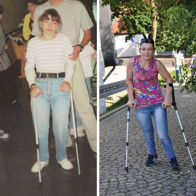 Kasia chodziła o kulach odkąd skończyła 7 lat