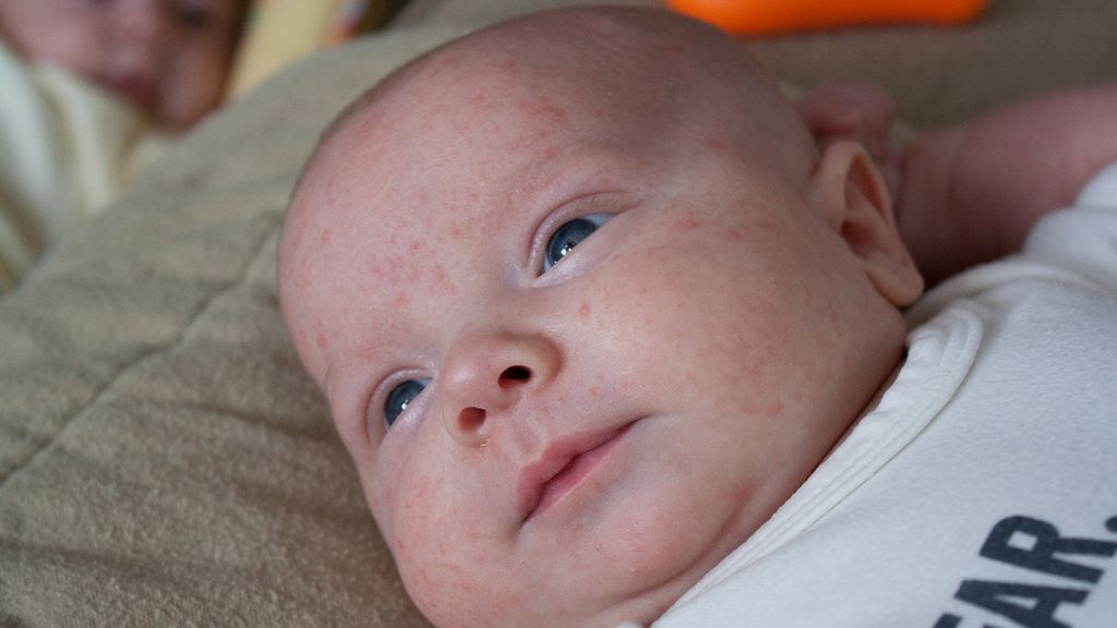 Trądzik niemowlęcy nie powinien wzbudzać niepokoju