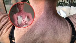 Skóra stała się więzieniem. Leczenie okazało się jeszcze gorsze 