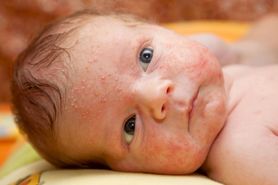 Wysypka u dziecka - alergia, choroby, infekcje