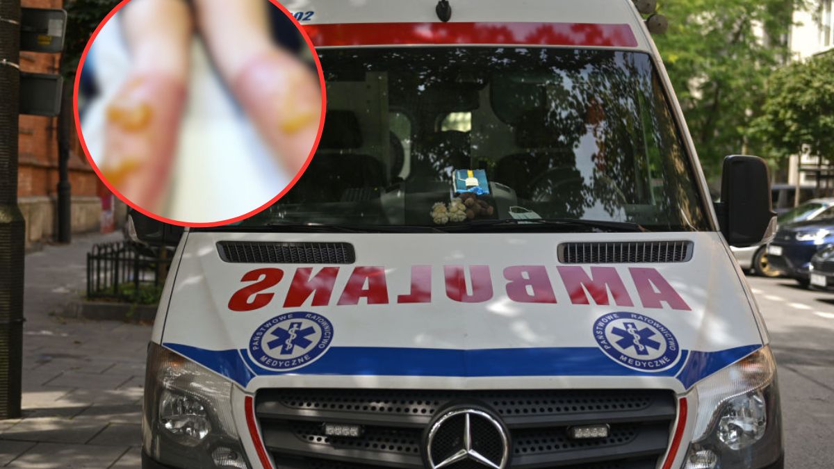 Medycy ostrzegają przed nadmierną ekspozycją na słońce