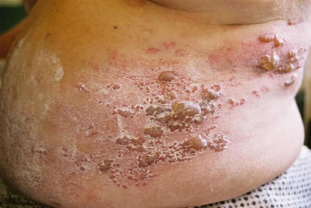 Pacjent z półpaścem