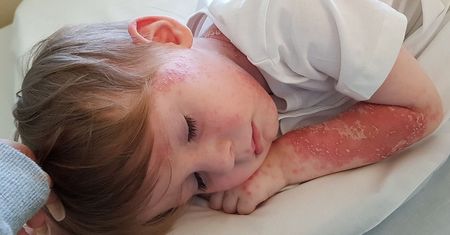Rzadka choroba sprawia, że chłopiec "zrzuca skórę jak wąż"