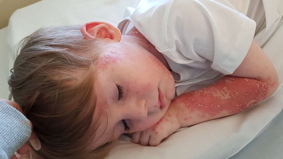 Rzadka choroba sprawia, że chłopiec "zrzuca skórę jak wąż"